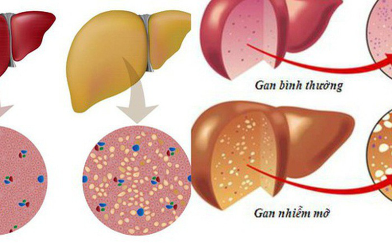 Gan nhiễm mỡ là gì